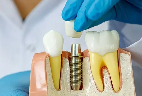 Dental Implants
